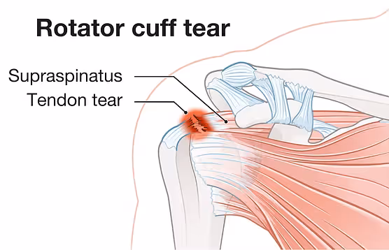 Featured image for Early surgical treatment recommended for post traumatic Rotator cuff tears in the shoulder.